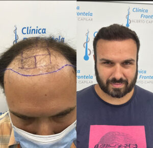Clínica Frontela - Injerto Capilar Málaga